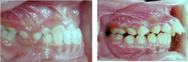 鄭信忠認為，兒童如果出現倒咬（左）、嚴重暴牙（右）會較嚴重影響牙齒功能，建議早點開始矯正治療。鄭信忠提供